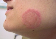 CHÀM ĐỒNG TIỀN LÀ GÌ ? CÁCH PHÒNG NGỪA VÀ ĐIỀU TRỊ