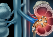 XÉT NGHIỆM NƯỚC TIỂU PHÁT HIỆN CÁC BỆNH THẬN SAU