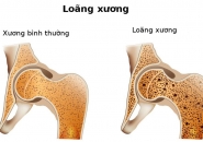 TRIỆU CHỨNG NGUYÊN NHÂN VÀ CÁCH KHẮC PHỤC LOÃNG XƯƠNG Ở TRẺ EM