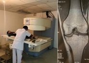 TÌM HIỂU VỀ ĐIỀU TRỊ KHỚP GỐI DO CHẤN THƯƠNG THỂ THAO