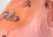 GẮP 50 CON SÁN TRONG ỐNG MẬT NGƯỜI ĐÀN ÔNG