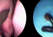 PHÁT HIỆN CON VẮT TRONG HỐC MŨI CÔ GÁI