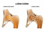 5 Điều Mọi Người Nên Biết Về Bệnh Loãng Xương