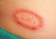 CHÀM ĐỒNG TIỀN VÀ NHỮNG ĐIỀU BẠN CHƯA BIẾT