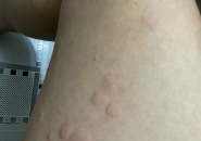 Bệnh Giun Lươn Strongyloides: Nguy Hiểm Nhưng Dễ Bỏ Sót