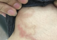 Xét Nghiệm Bệnh Ngứa Ở Da