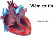 BIỂU HIỆN , NGUYÊN NHÂN VIÊM CƠ TIM SIÊU VI Ở TRẺ EM