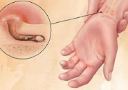 Bệnh Ghẻ: Nguyên Nhân, Dấu Hiệu Và Phác Đồ Điều Trị Hiệu Quả