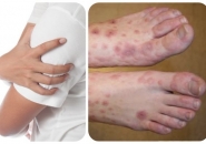 BỆNH GIUN CHỈ BẠCH HUYẾT