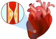NGƯỜI TRẺ BỊ NHỒI MÁU CƠ TIM