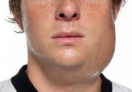 BỆNH QUAI BỊ GÂY NHỀU BIẾN CHỨNG NGUY HIỂM