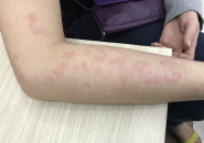 Bệnh sán chó: Những điều cần biết về bệnh sán chó ở Toxocara
