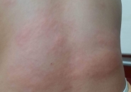 Người Đàn Ông Phát Ban Mẩn Đỏ Khắp Người, Sau Ba Tháng Mới Tìm Ra Nguyên Nhân