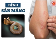 Bệnh Sán Máng Schistosomiasis: Triệu Chứng Và Cách Phát Hiện Sớm