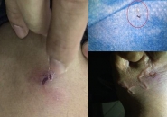 Bị Ngứa Ở Lưng Sau Khi Tắm Biển Là Bệnh Gì?