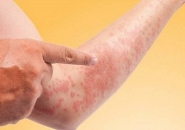 MỘT SỐ BỆNH NGỨA DA THƯỜNG GẶP