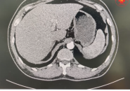 Tổng Quan Về Bệnh Sán Lá Gan: Nguyên Nhân, Con Đường Lây Truyền Và Cách Điều Trị Hiệu Quả