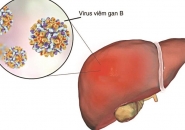 Có Uống Thuốc Trị Sán Chó Toxocara Khi Đang Điều Trị Viêm Gan B Và Tiểu Đường Type 2 Được Không?