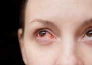 BỆNH ĐAU MẮT ĐỎ - NGUYÊN NHÂN VÀ CÁCH ĐIỀU TRỊ