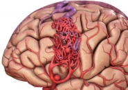 NGUY HIỂM TÍNH MẠNG NẾU BỊ DỊ DẠNG MẠCH MÁU NÃO