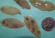 Điều trị bệnh sán lá gan ở đâu?