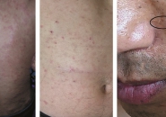 GIUN TRÒN CHUI DƯỚI DA NGƯỜI