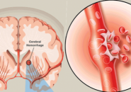 CÁCH PHÒNG TRÁNH XUẤT HUYẾT NÃO