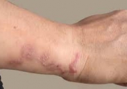 Chẩn Đoán Và Phòng Ngừa Bệnh Sán Dây Lợn