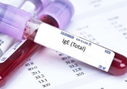 Kết Quả Xét Nghiệm Máu Có Chỉ Số IgE Tăng Cao: Nguyên Nhân Và Cách Điều Trị Hiệu Quả