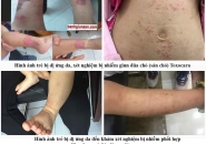 Khi Trẻ Bị Dị Ứng Da Cần Làm Xét Nghiệm Gì Tìm Nguyên Nhân Dị Ứng Da