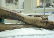 ĐỀ PHÒNG BỆNH CHẾT NGƯỜI TỪ VIỆC ĂN TIẾT CANH LỢN ĐÓN TẾT