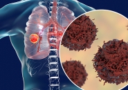 UNG THƯ PHỔI  NHỮNG ĐIỀU CẦN BIẾT