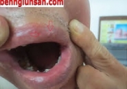 Mẩn Ngứa Da Nổi Mề Đay Có Phải Do Nhiễm Giun Sán?