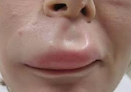 Tại Sao Nhiễm Giun Sán Lại Khiến Da Bị Ngứa Rát Nổi Mẩn Liên Tục?