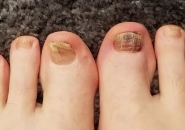 5 DẤU HIỆU Ở MÓNG CHÂN CẦN ĐI KHÁM GẤP