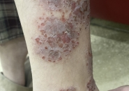 Ngứa Da Lâu Ngày Ở Trẻ: Cẩn Thận Ấu Trùng Giun Sán Toxocara