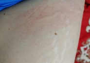 Ngứa da, nổi mề đay kéo dài: Cảnh báo nhiễm giun sán Toxocara