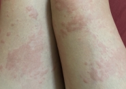 Ngứa Da Nổi Mề Đay Kéo Dài – Coi Chừng Nhiễm Ấu Trùng Giun Sán! Tiến sĩ BS Nguyễn Hằng Lan Tư Vấn