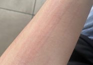 Ngứa Khắp Người, Có Phải Nhiễm Sán Chó?
