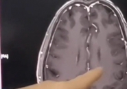 Người Đàn Ông Não Chi Chít Sán Chỉ Vì Một Món Ăn