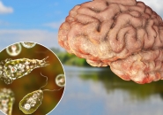 NHIỄM TRÙNG NÃO DO AMIP, VIÊM MÀNG NÃO DO AMIP NGUYÊN PHÁT