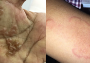 SỐ NGƯỜI NHIỄM GIUN SÁN Ở KHÁNH HÓA