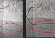 NGƯỜI PHỤ NỮ SUÝT CHẾT VÌ BỆNH NHỒI MÁU CƠ TIM