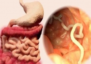 NHỮNG THẮC MẮC THƯỜNG GẶP VỀ GIUN SÁN