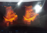 Hình Ảnh Siêu Âm Gan Có Nốt Âm, Có Phải Nang Sán Không?