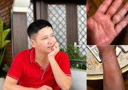 NSƯT Chí Trung Phát Hiện Nhiễm Sán Chó Toxocara Sau Nhiều Tháng Ngứa Kéo Dài