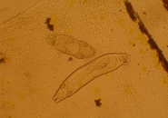 BỆNH SÁN LÁ GAN LÀ GÌ ? DẤU HIỆU VÀ CÁCH PHÒNG BỆNH