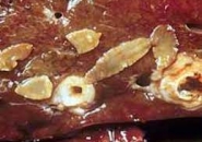 Sán lá gan: Phương pháp điều trị và chi phí chữa bệnh sán lá gan