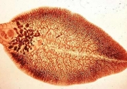 BỆNH DO SÁN LÁ LỚN Ở GAN 