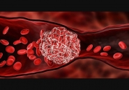 DẤU HIỆU NHẬN BIẾT CỦA  TẮC NGHẼN  MẠCH MÁU TRONG PHỔI